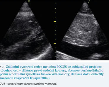 Obr. 2 Základní vyšetření srdce metodou POCUS ze subkostální projekce na dlouhou osu – dilatace pravé srdeční komory, absence perikardiálního výpotku a normální systolická funkce levé komory, dilatace dolní duté žíly s omezenou respirační kolapsibilitou. 23-1_70b