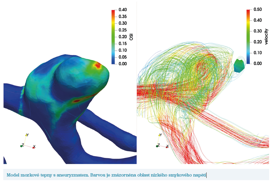 Model mozkové tepny s&nbsp;aneuryzmatem. Barvou je znázorněna oblast nízkého smykového napětí