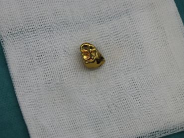 Náhrada zápěstní kůstky Náhrada zápěstní kůstky