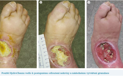 Obr. 1–3 Použití HydroCleanu