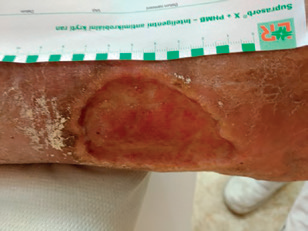 Obr. 1 Defekt pravé dolní končetiny po&nbsp;první hospitalizaci