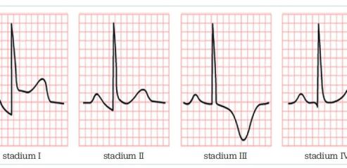Obr. 1 EKG změny u&nbsp;akutní perikarditis – vývoj změn PR a&nbsp;ST úseků ve&nbsp;čtyřech stadiích. Zdroj: Gibson CM, Najafi H. Pericarditis electrocardiogram – wikidoc. https://en.ecgpedia.org/wiki/Main