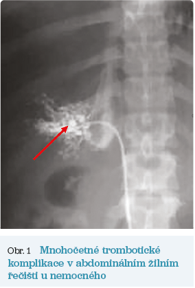Obr. 1 Mnohočetné trombotické komplikace