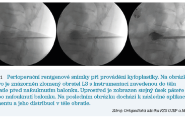 Obr. 1 Perioperační rentgenové snímky při&nbsp;provádění kyfoplastiky