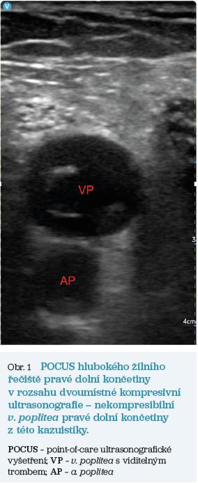 Obr. 1 POCUS hlubokého žilního řečiště pravé dolní končetiny v rozsahu dvoumístné kompresivní ultrasonografie – nekompresibilní v. poplitea pravé dolní končetiny z této kazuistiky. Obr. 1 POCUS hlubokého žilního řečiště pravé dolní končetiny v rozsahu dvoumístné kompresivní ultrasonografie – nekompresibilní v. poplitea pravé dolní končetiny z této kazuistiky.