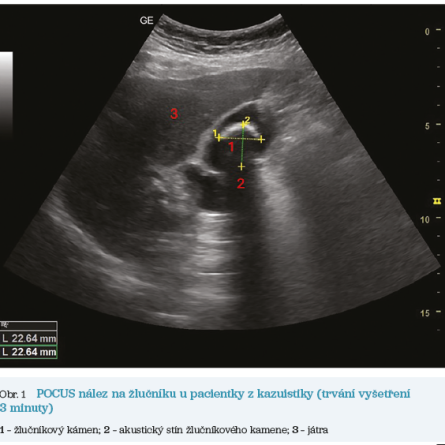 Obr. 1 POCUS nález na&nbsp;žlučníku u&nbsp;pacientky z&nbsp;kazuistiky