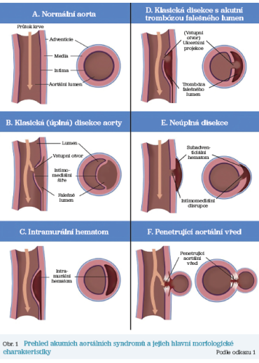Obr. 1 Přehled akutních aortálních syndromů a&nbsp;jejich hlavní morfologické charakteristiky