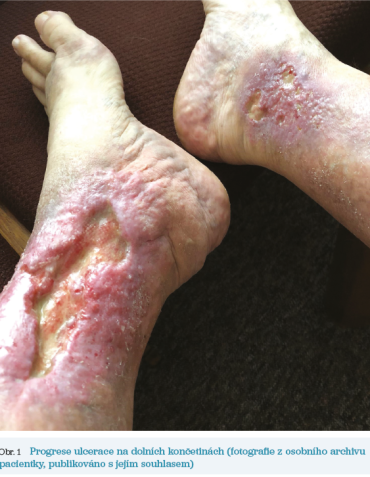 Obr. 1 Progrese ulcerace na&nbsp;dolních končetinách