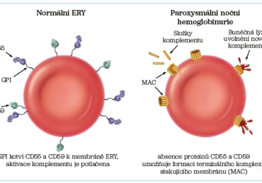Obr. 1 Schéma vzniku hemolýzy u&nbsp;paroxysmální noční hemoglobinurie ERY – erytrocyty; GPI – glykosylfosfatidylinositol; MAC – komplex atakující membránu (membrane attack complex)