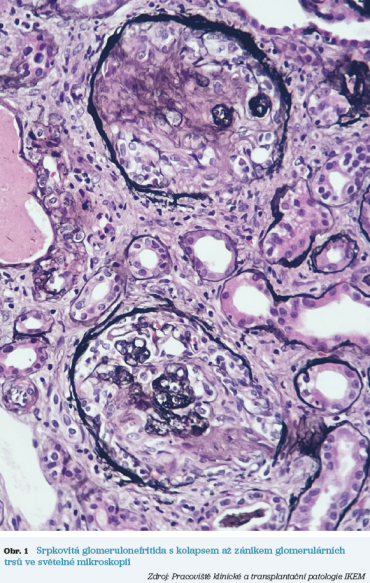 Obr. 1 Srpkovitá glomerulonefritida