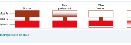Obr. 1 Stadia sideropenické anémie