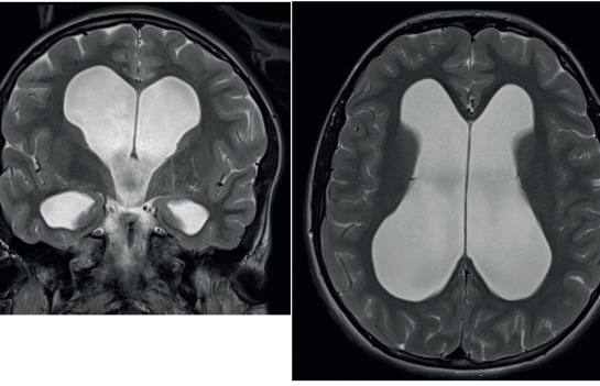 Obr. 1 T2 vážený obraz MR v&nbsp;axiální a&nbsp;koronární rovině. Viditelná výrazná dilatace komorového systému. MR – magnetická rezonance