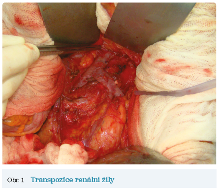 Obr. 1 Transpozice renální žíly
