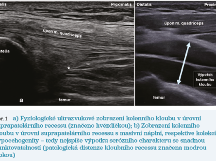 Obr. 1 Ultrazvukové zobrazení kolenního kloubu