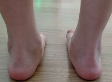 Obr. 1 Valgozita pat a&nbsp;vyklenutí mediálních kotníků u&nbsp;pacienta s&nbsp;plochonožím