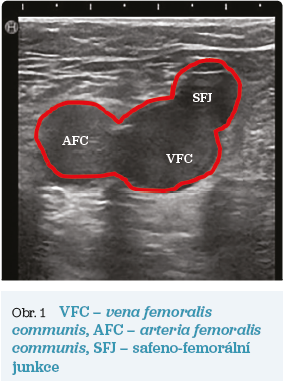 Obr. 1 VFC – vena femoralis