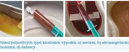 Obr. 1 Vzhled jednotlivých typů kloubních výpotků