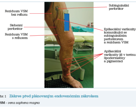 Obr. 1 Zákres před&nbsp;plánovaným endovenózním zákrokem