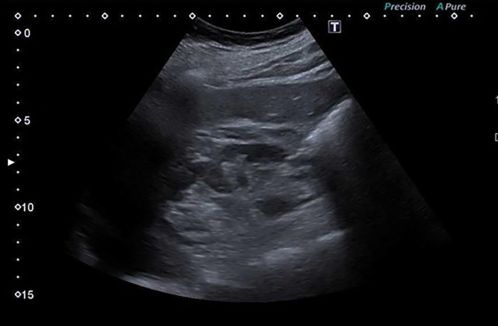 Obr. 1 Známky chronické nefropatie v&nbsp;UZ zobrazení – převažuje redukce parenchymové vrstvy ledviny. Přítomna je také lipomatóza sinu UZ – ultrazvuk
