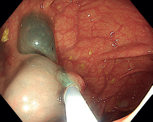 Obr. 10 Léze uchopená mukosektomickou kličkou.