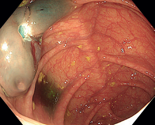 Obr. 11 Spodina po&nbsp;resekci bez&nbsp;známek perforace.