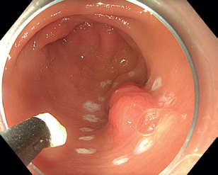 Obr. 12 Objemná léze v&nbsp;žaludku označená koagulačními body.