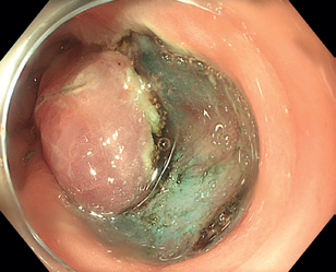 Obr. 13 Částečně disekovaná léze.