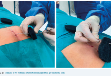 Obr. 1A, 1B Dimise je ve&nbsp;většině případů možná již třetí pooperační den