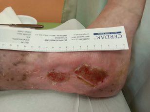 Obr. 2 Defekt levé dolní končetiny po první hospitalizaci Obr. 2 Defekt levé dolní končetiny po první hospitalizaci