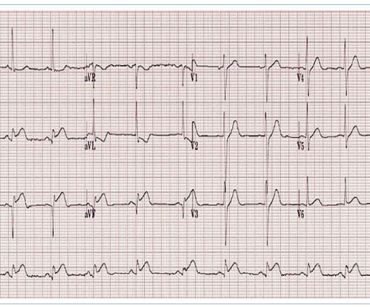 Obr. 2 EKG křivka u&nbsp;akutní perikarditis – repolarizační změny PR a&nbsp;ST úseků. Zdroj: Bray J, Meghji S. Pericarditis – ECG interpretation. https://xerte.cardiff.ac.uk