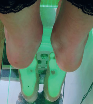 Obr. 2 Kombinace klinického nálezu s&nbsp;plantoskopickým zobrazením.