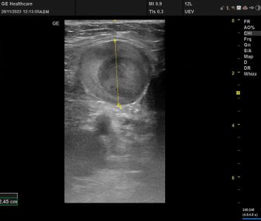 Obr. 2 Lumen VSM na&nbsp;levé dolní končetině před&nbsp;plánovaným zákrokem
