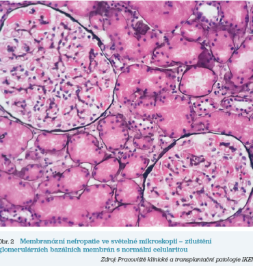 Obr. 2 Membranózní nefropatie