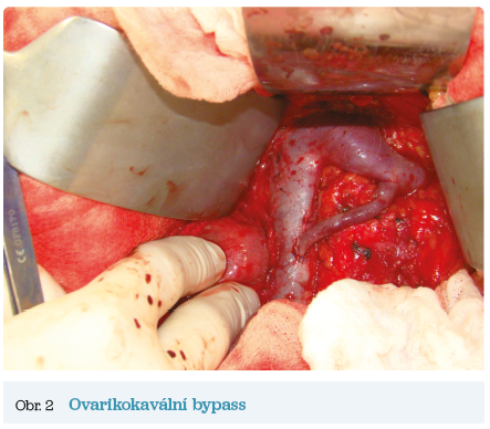 Obr. 2 Ovarikokavální bypass