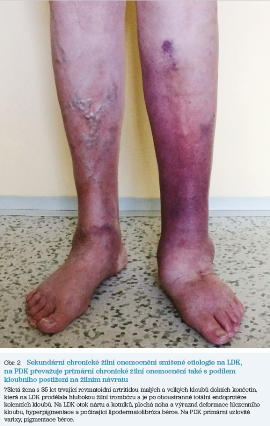 Obr. 2 Sekundární chronické žilní onemocnění