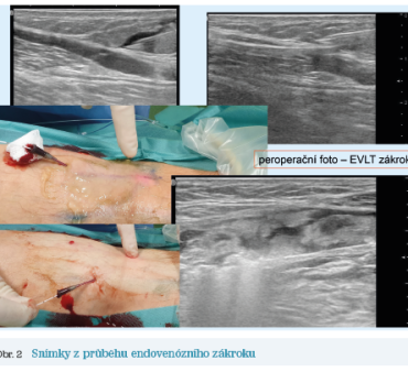 Obr. 2 Snímky z&nbsp;průběhu endovenózního zákroku