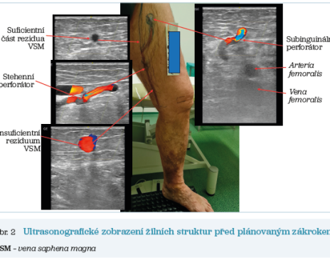 Obr. 2 Ultrasonografické zobrazení žilních struktur před&nbsp;plánovaným zákrokem