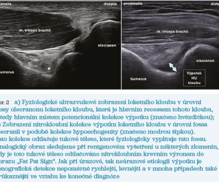 Obr. 2 Ultrazvukové zobrazení loketního kloubu