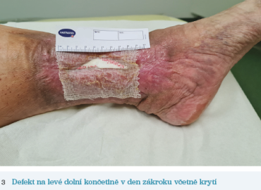 Obr. 3 Defekt na&nbsp;levé dolní končetině v&nbsp;den zákroku včetně krytí