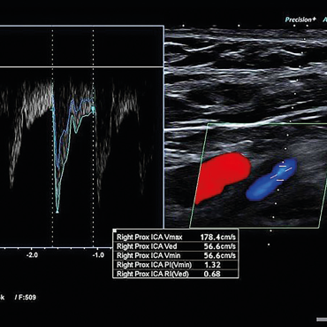 Obr. 3 Duplexní sonografie s&nbsp;obrazem symptomatické stenózy pravé ACI 80–85 % ACI – arteria carotis interna