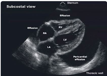 Obr. 3 Echokardiografické zobrazení perikarditis s&nbsp;rozsáhlým výpotkem – subkostální pohled.