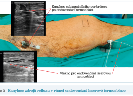 Obr. 3 Kanylace zdrojů refluxu v&nbsp;rámci endovenózní laserové termoablace