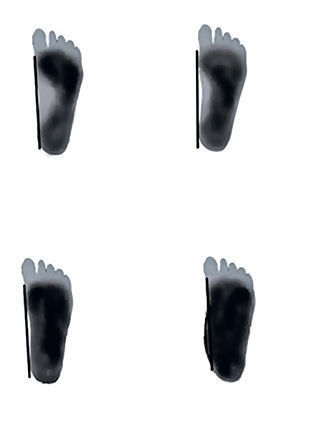 Obr. 3 Klasifikace dle&nbsp;plantoskopického nálezu.