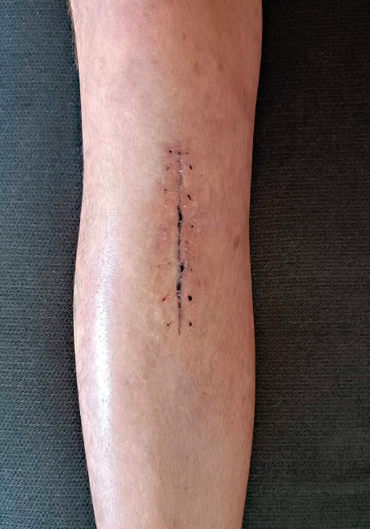 Obr. 3 Kontrola po&nbsp;14 dnech, rána klidná