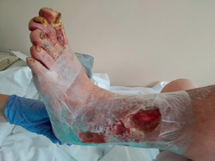 Obr. 3 Příprava naložení systému NPWT, při&nbsp;převazu již patrno zlepšení defektů