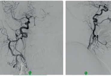 Obr. 3 Retrográdní tok v&nbsp;bazilární tepně cestou zadní komunikanty z&nbsp;povodí karotidy.
