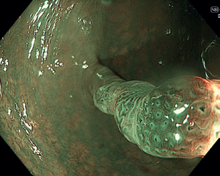 Obr. 3 Stopkatý polyp 0‑Ip zobrazený metodou Narrow Band Imaging.