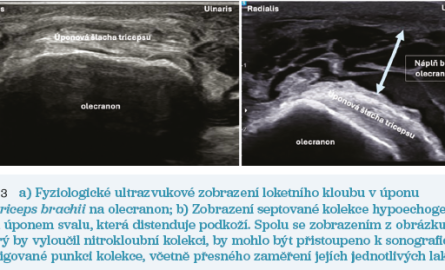 Obr. 3 Ultrazvukové zobrazení loketního kloubu