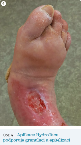 Obr. 4 Aplikace HydroTacu