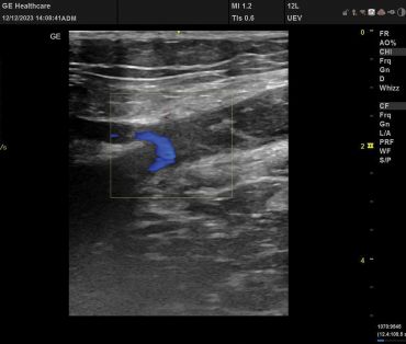 Obr. 4 Nález po&nbsp;endovenózním zákroku
